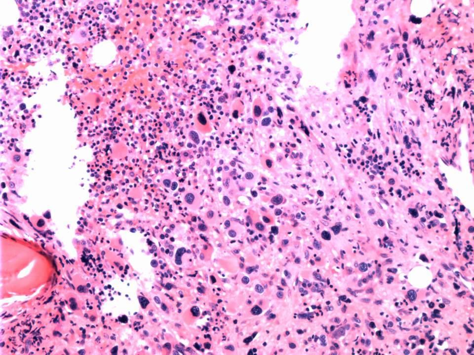 Megakaryocytes are markedly increased.